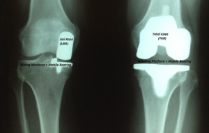 Knee Arthritis - Dr. Roger Chams