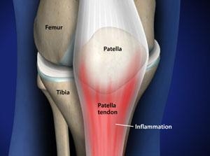 What is Patellar Tendonitis? - Dr. Roger Chams