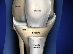 What is Patellar Tendonitis? - Dr. Roger Chams