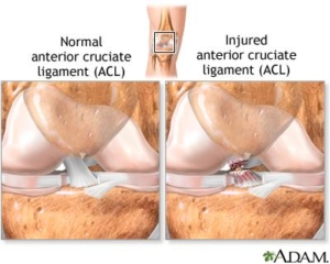 ACL tear treatment without surgery