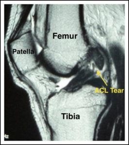 What is an ACL Injury and Reconstrcution? - Dr. Roger Chams