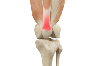 What is Patellar Tendonitis? - Dr. Roger Chams